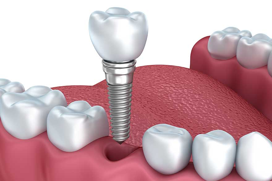 Pay attention to these factors when getting dental implants